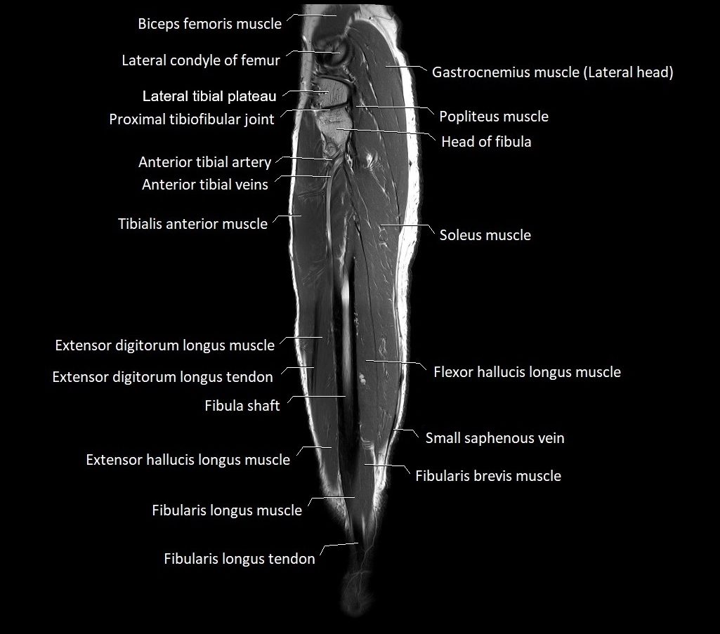 Lower leg sagittal anatomy 3T MRI image 10.webp
